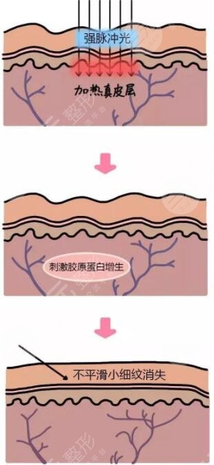 点阵激光美容的原理是什么?