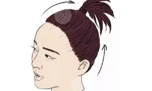 发际线种植