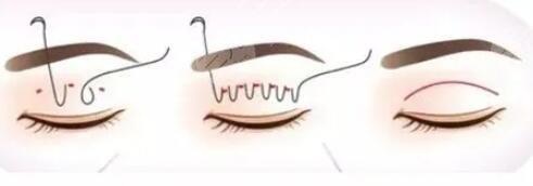 在东营人民医院做双眼皮手术之前