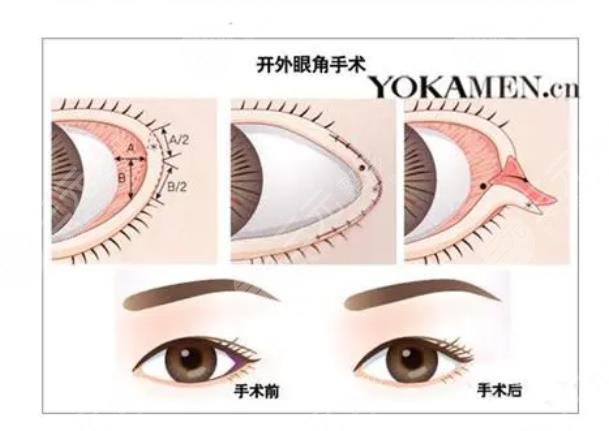 开外眼角手术