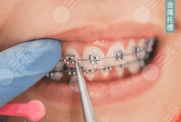 金属矫正牙齿需要多久时间?