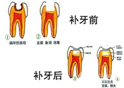 2020湘雅附二补牙费用 口腔美容价格大全