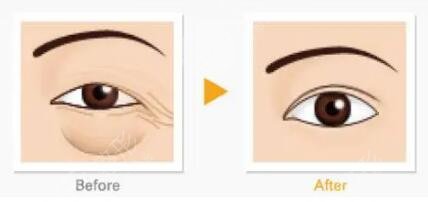 岳阳去眼袋案例反馈