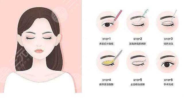 双眼皮