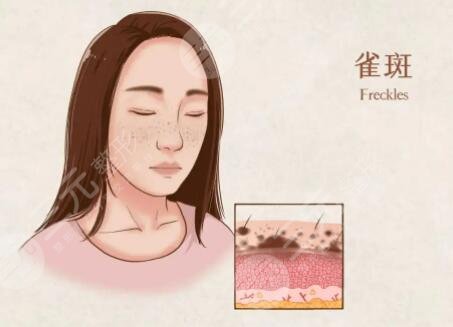 河南郑州激光祛斑案例反馈