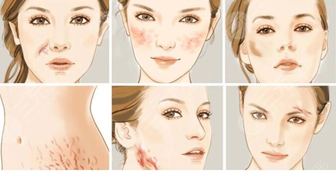 济南祛疤手术项目案例体验反馈: