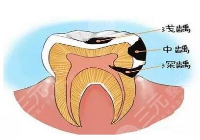 沙井人民医院牙科补牙案例