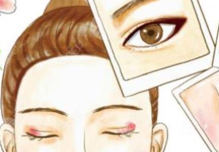 双眼皮