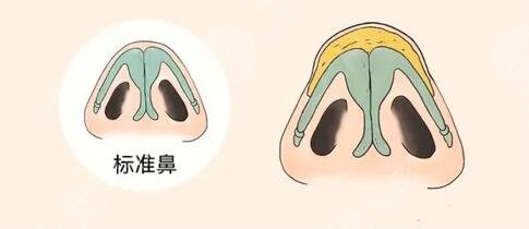 注射隆鼻
