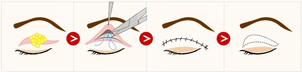 清远人民医院美容整形科热门项目: