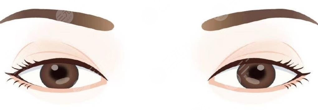 开眼角
