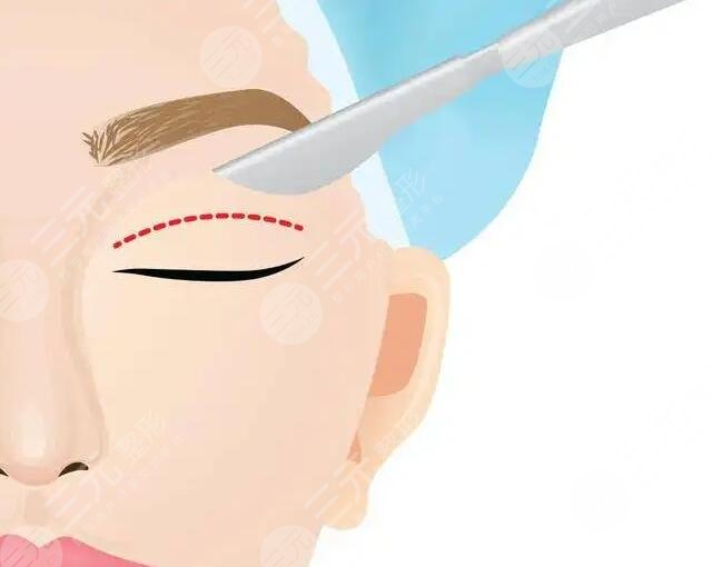 全切双眼皮手术