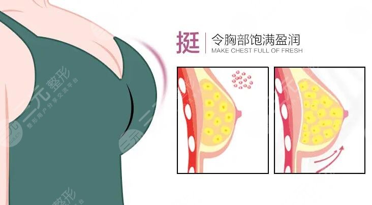 自体脂肪隆胸手术