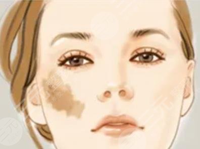 胎记