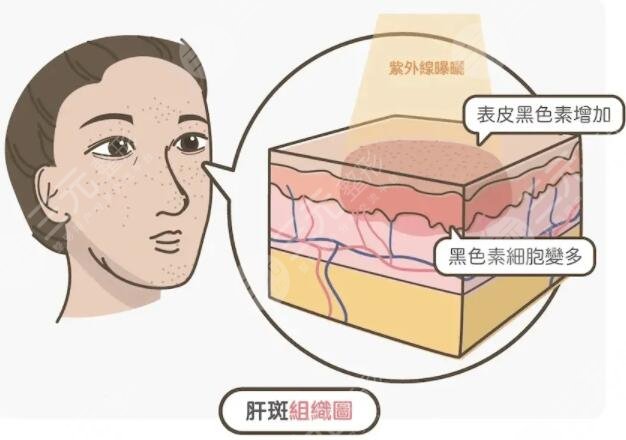 色斑是如何形成的?