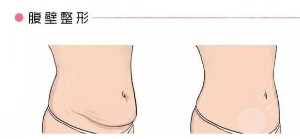 腹壁成形术