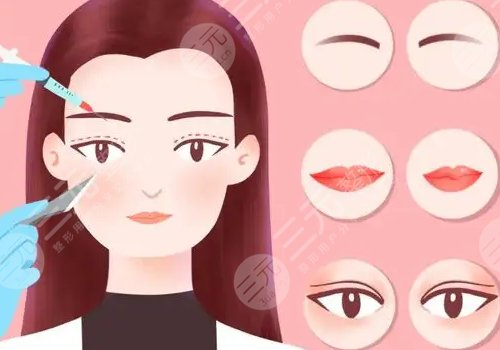 成都米兰柏羽割双眼皮医生介绍