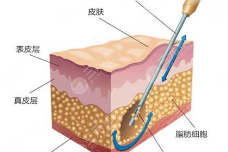 吸脂