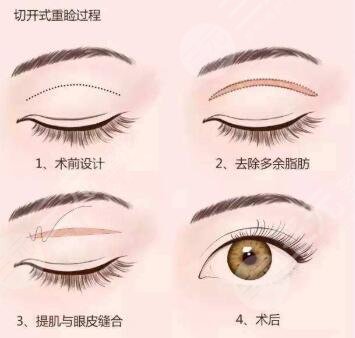 双眼皮整形