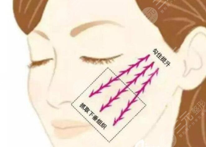 埋线提升