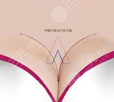 隆胸