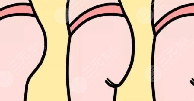 丰臀