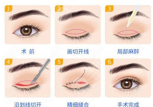 湖南雅美切双眼皮好吗?