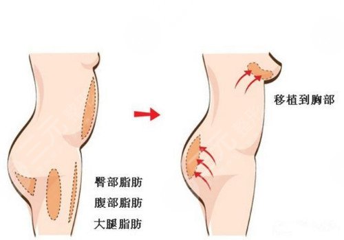 北京韩啸做自体脂肪丰胸医生介绍