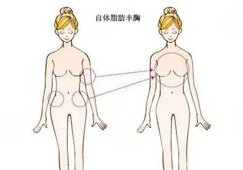 北京韩啸做自体脂肪丰胸医生介绍