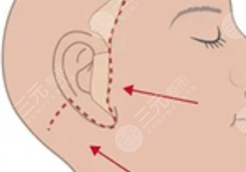 北京黄寺医疗美容诊所做拉皮手术好吗?