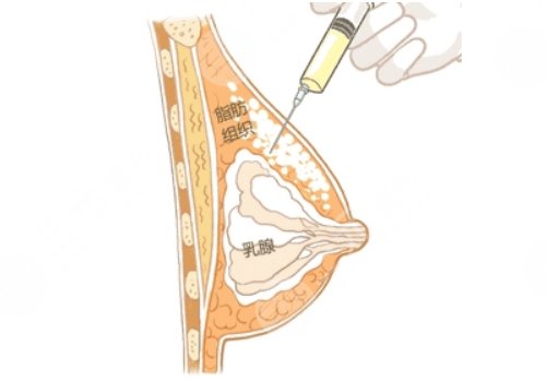 现在贵阳利美康假体隆胸技术怎么样?