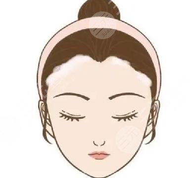 发际线种植