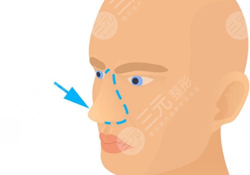 郑州美莱做鼻子怎么样?