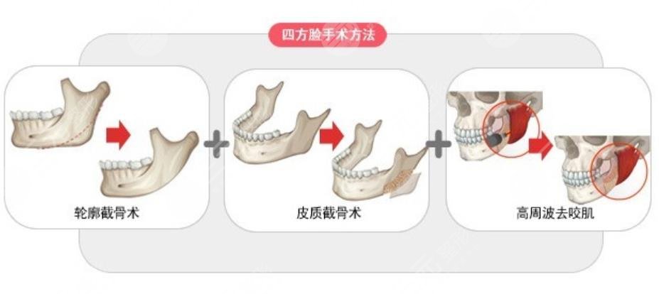 下颌角