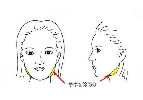 北京联合丽格磨骨怎么样?