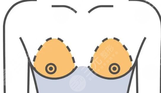 隆胸