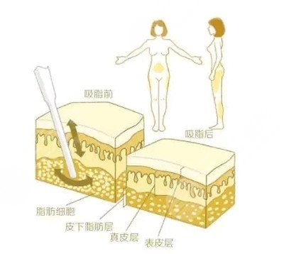 吸脂