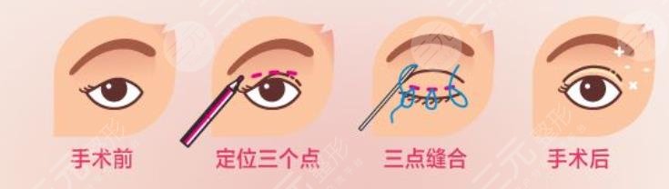 双眼皮