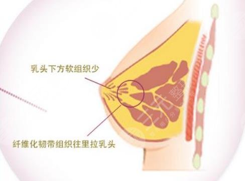 隆胸