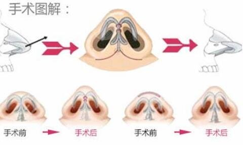 鼻综合整形术