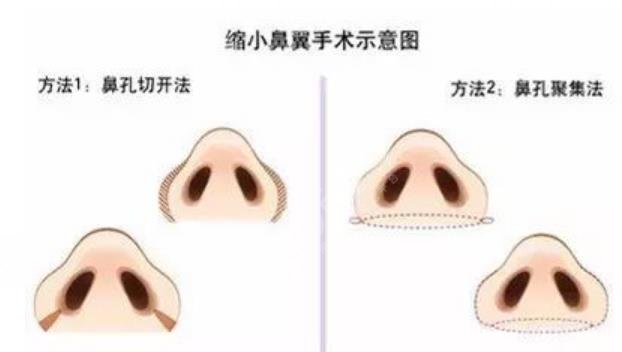 鼻翼缩