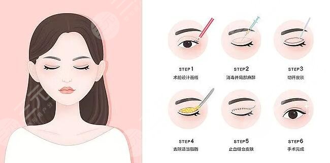 上海九院割双眼皮注意事项