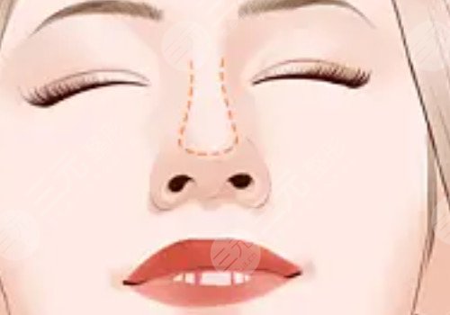 贵阳美莱做鼻子怎么样？