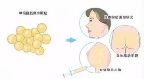 自体脂肪