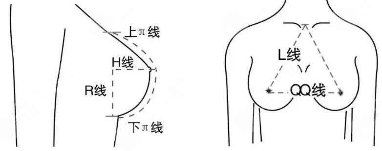 玻尿酸丰胸