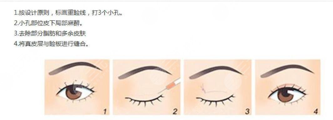 韩式双眼皮
