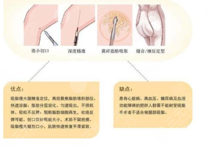 大腿吸脂