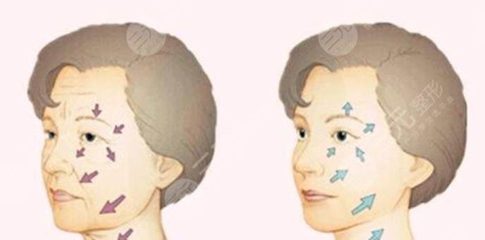 激光除皱