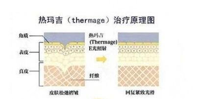 上海九院热玛吉效果好不好?
