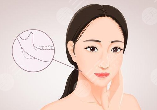 少女轮廓线提升打的什么针
